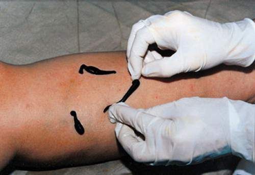 சுருள் சிரை நாளங்களில் எதிராக Leeches 