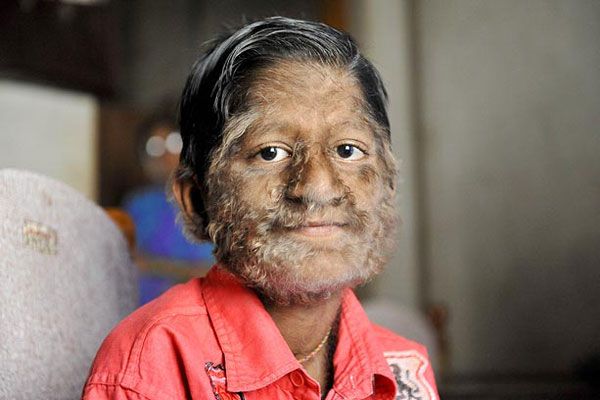 வேர்ல்போல் நோய்க்குறி