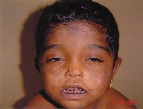 வாம்பயர் நோய்